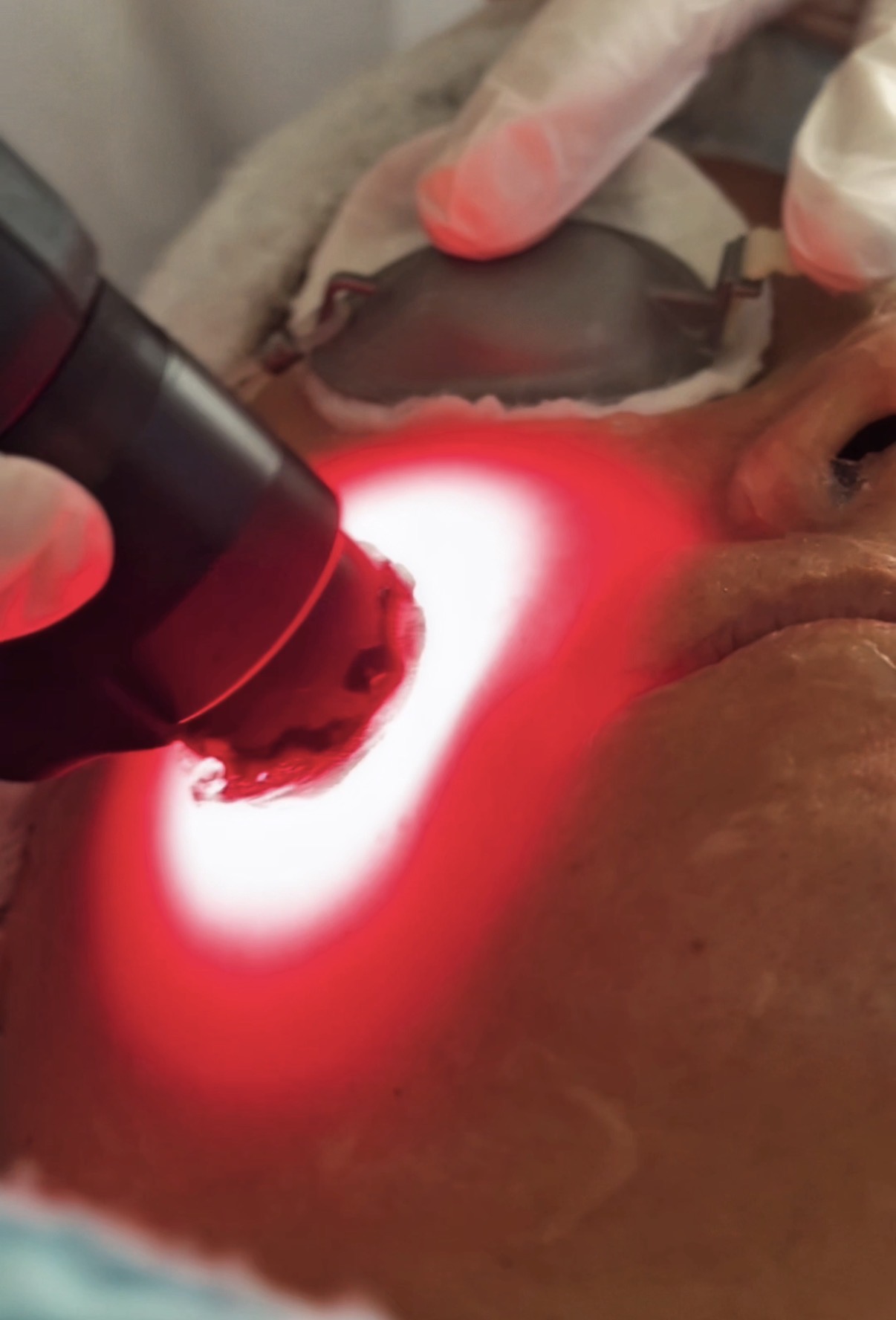 Nahaufnahme der RedTouch PRO Behandlung mit rotem Laserlicht auf der Haut